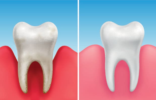 what is a periodontal scaling and root planing new